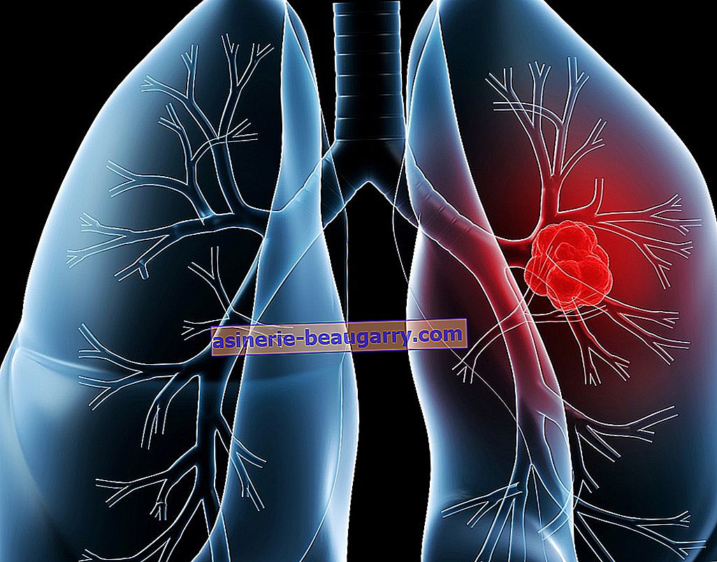 Symptômes, durée de vie et traitement du cancer du poumon