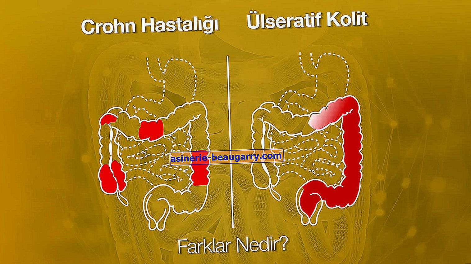 Qu'est-ce que la maladie de Crohn?